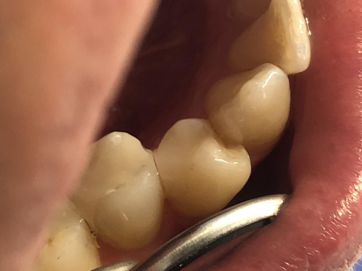 Un primo piano dei denti - trattamenti conservativa