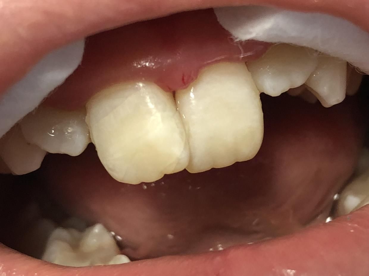 Un primo piano dei denti - trattamenti conservativa