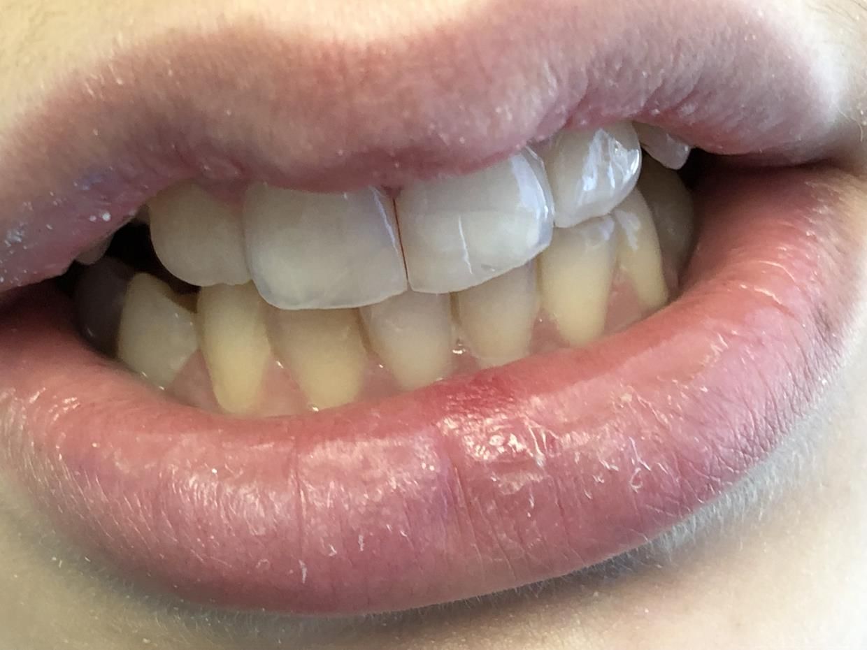 Un primo piano dei denti - trattamenti conservativa