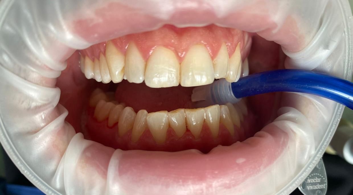 trattamenti di igiene dentale - bocca in primo piano