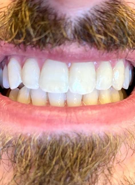 trattamenti di igiene dentale - bocca in primo piano