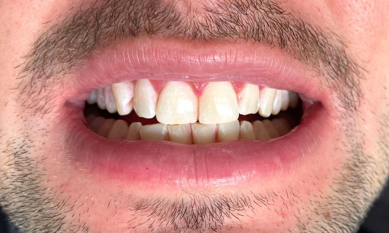 trattamenti di igiene dentale - bocca in primo piano