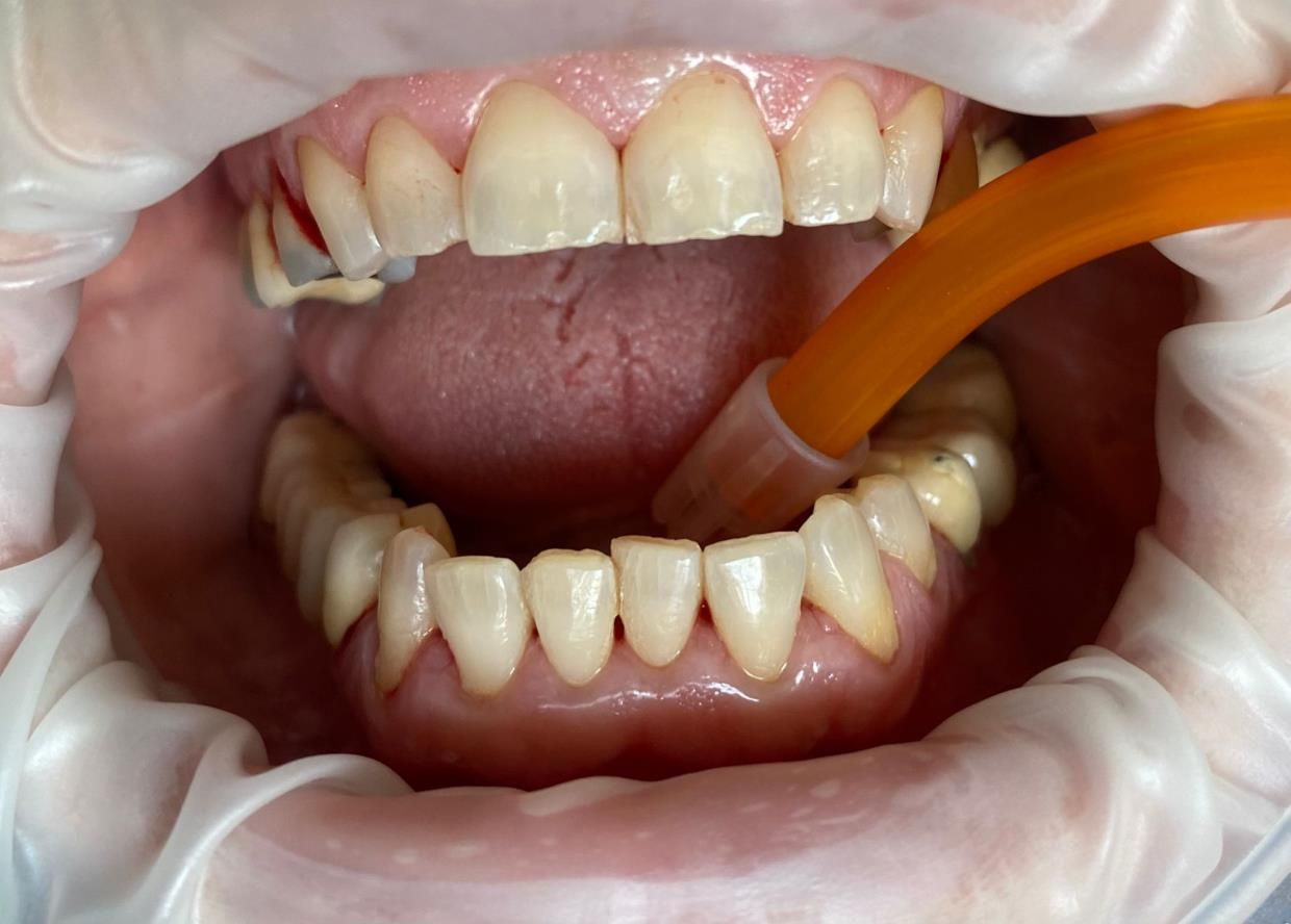 trattamenti di igiene dentale - bocca in primo piano