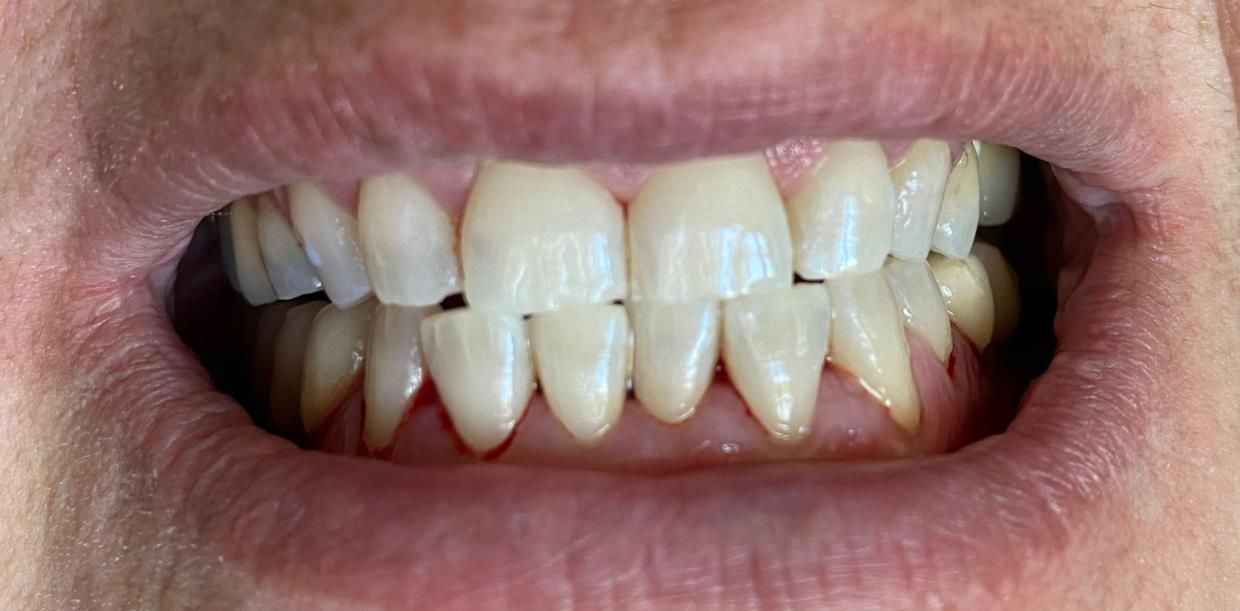 trattamenti di igiene dentale - bocca in primo piano