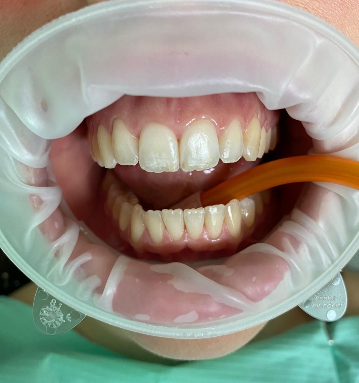 trattamenti di igiene dentale - bocca in primo piano