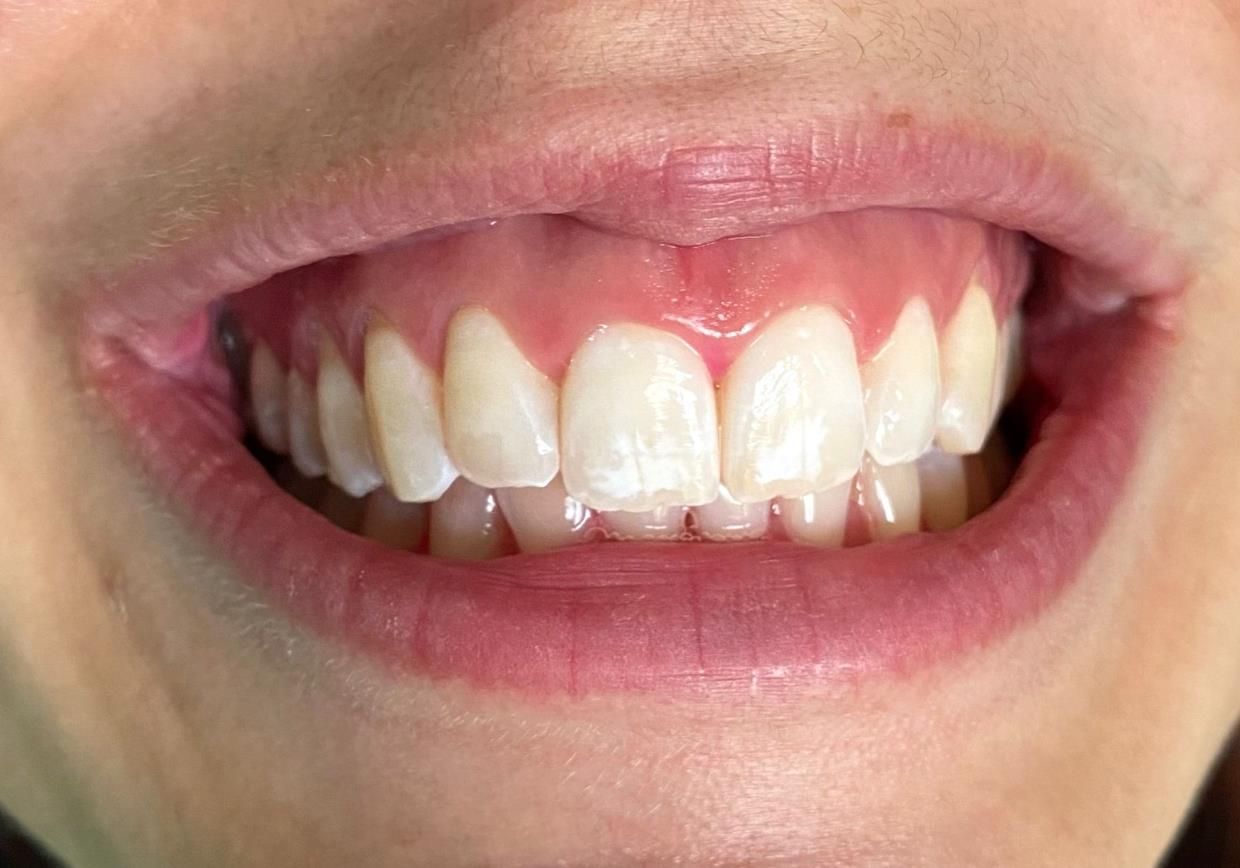 trattamenti di igiene dentale - bocca in primo piano