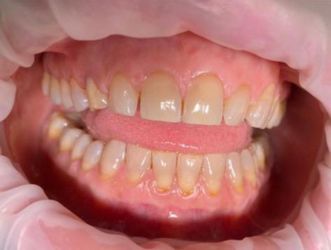 trattamenti di igiene dentale - bocca in primo piano
