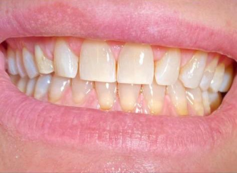 trattamenti di igiene dentale - bocca in primo piano