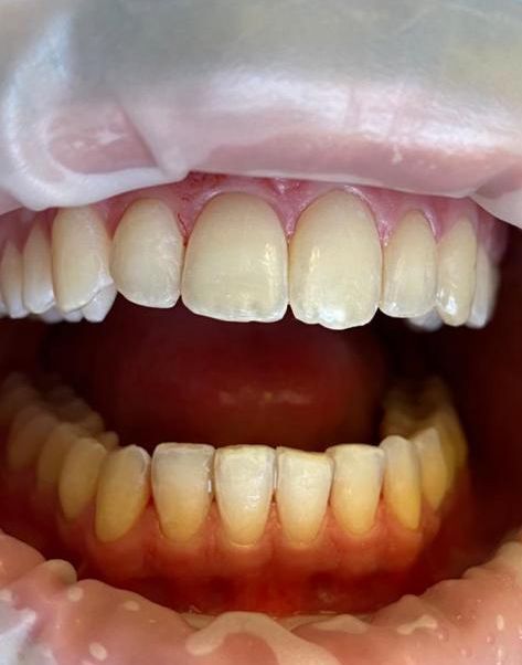 trattamenti di igiene dentale - bocca in primo piano