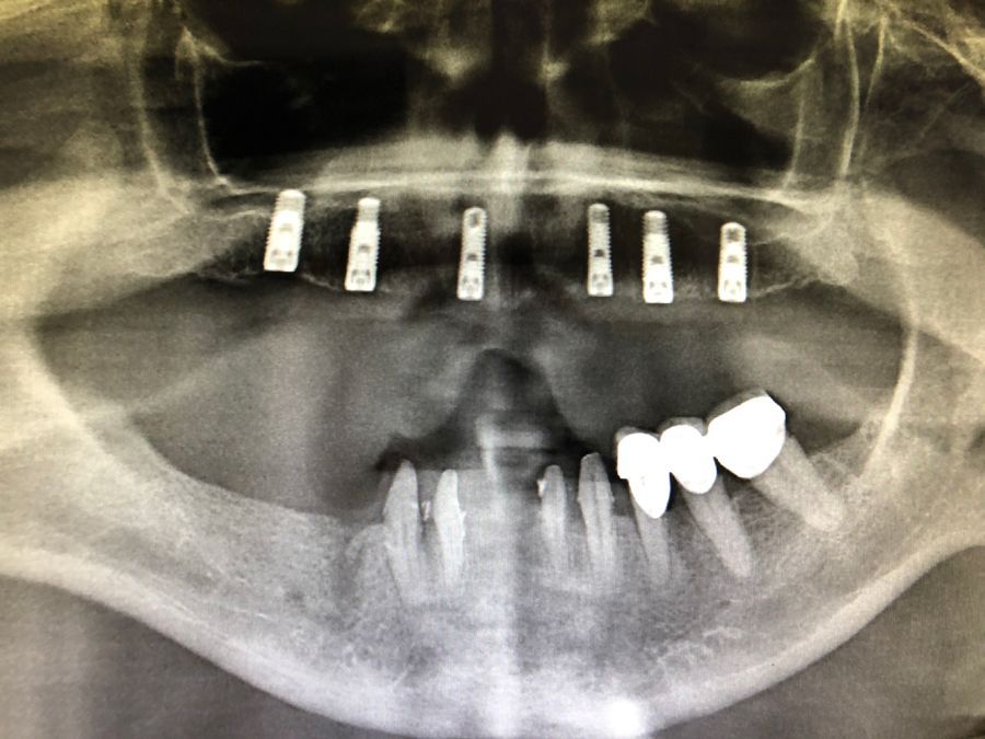 Una radiografia dei denti di una persona con impianti dentali.