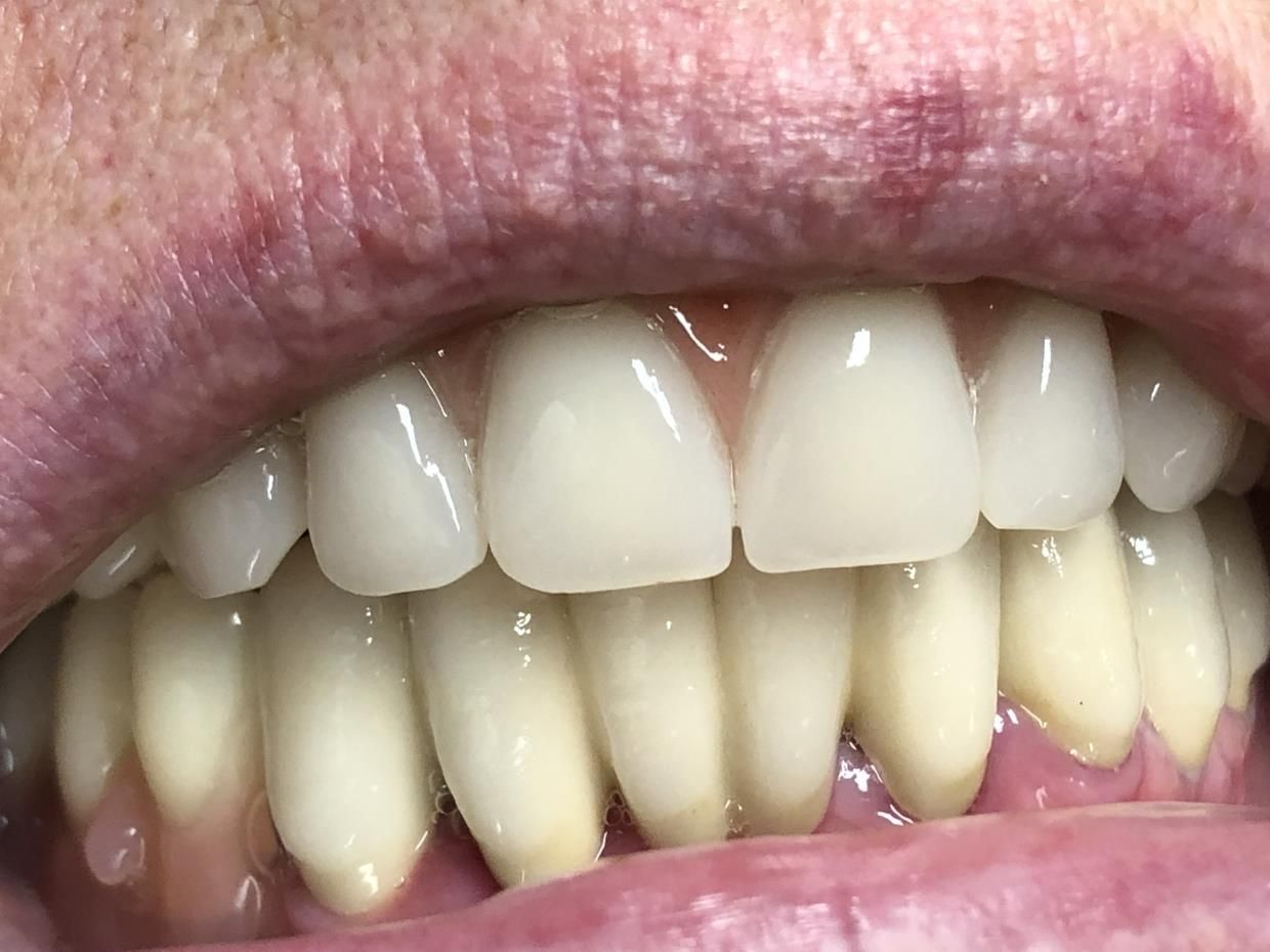 Un primo piano della bocca di una persona sequenza impianto di implantologia