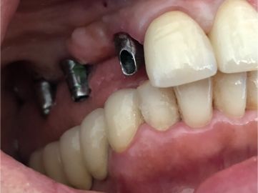 Un primo piano della bocca di una persona sequenza impianto di implantologia
