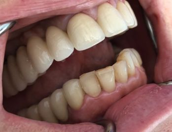 Un primo piano della bocca di una persona sequenza impianto di implantologia