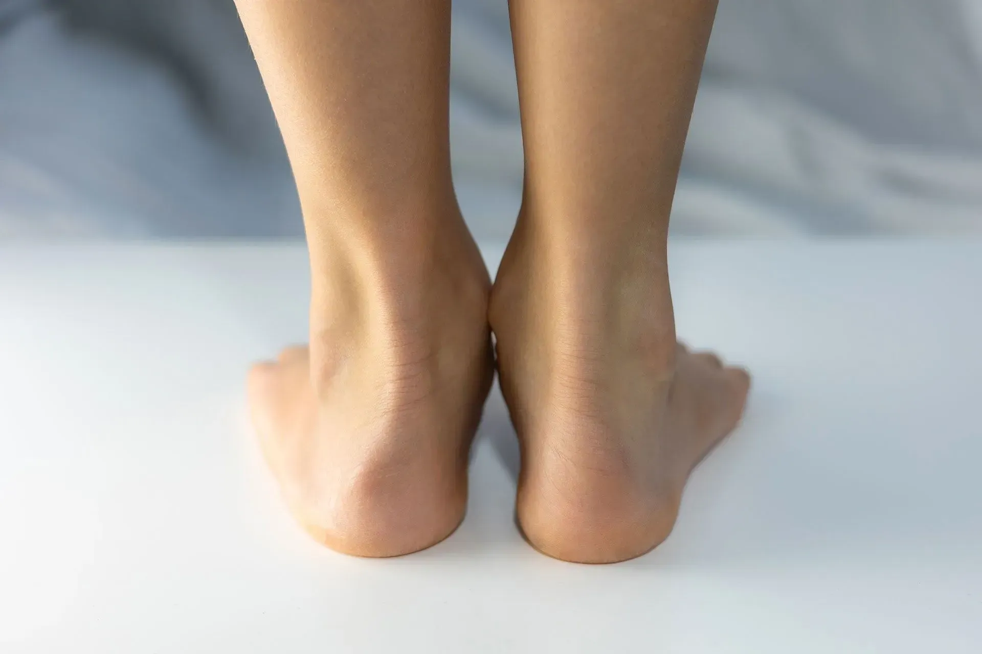 A rear view of two bare feet showing inward arch collapse, consistent with overpronation, against a plain white background.