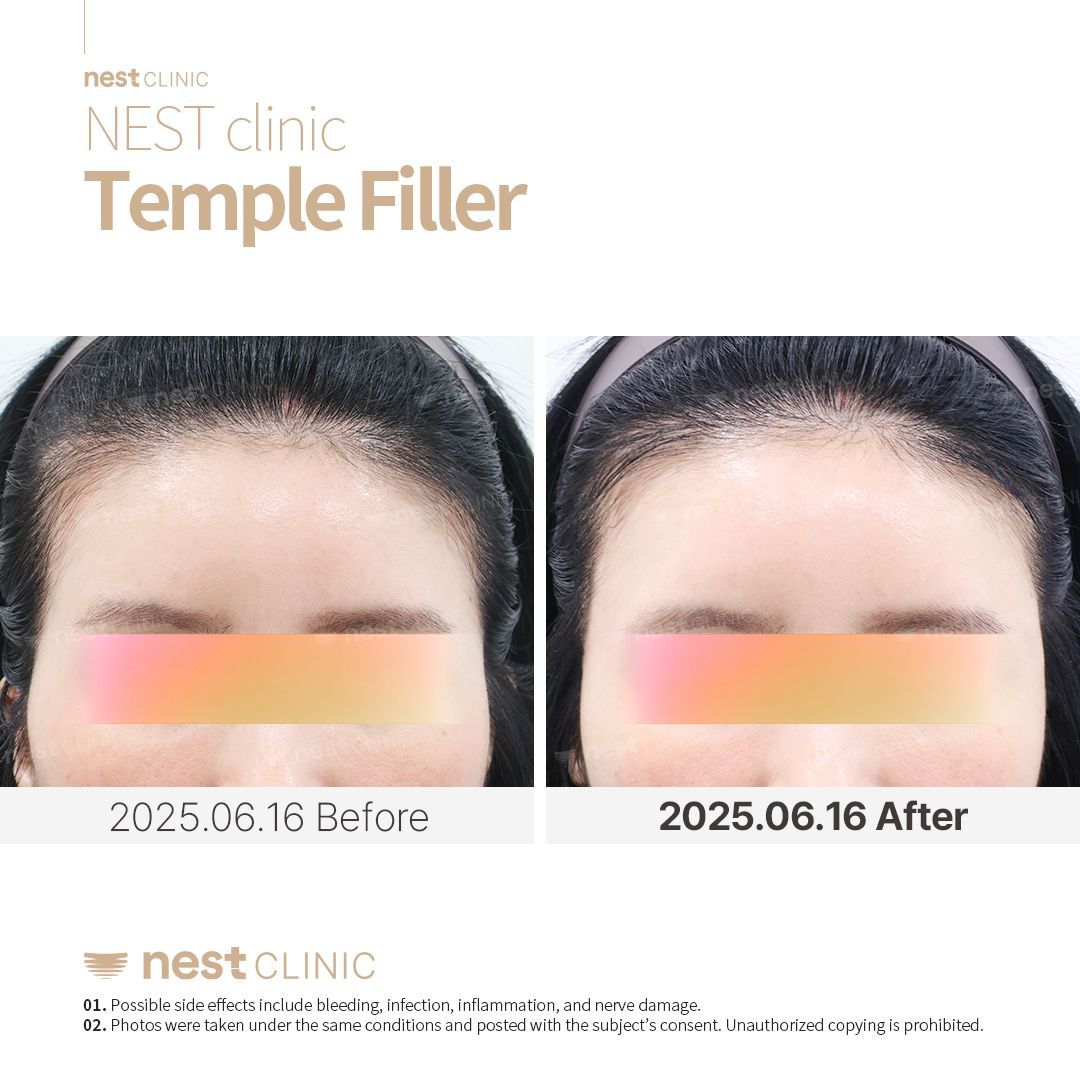 Temple Filler — Nest Clinic Gangnam