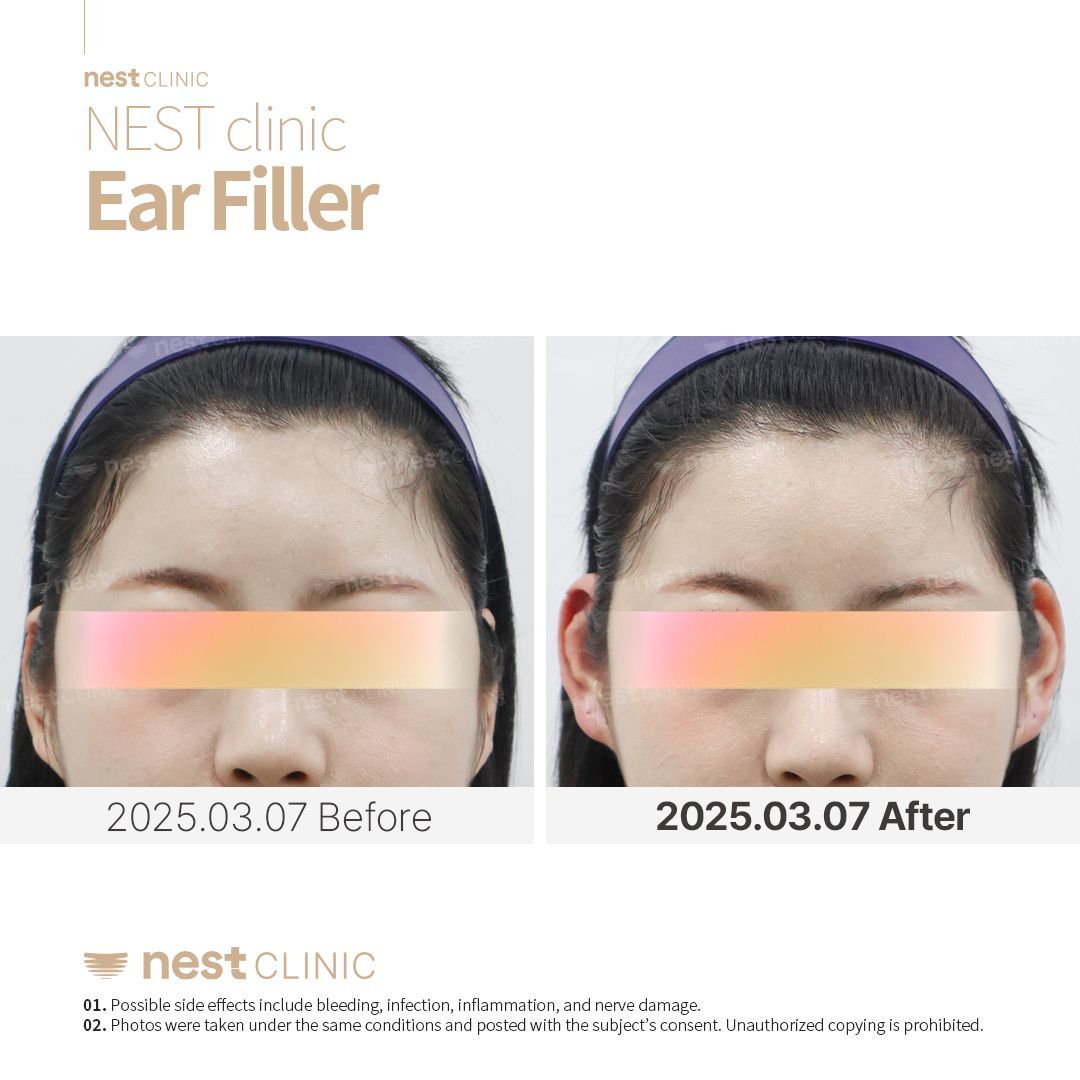 Ear Filler before and after — Nest Clinic Gangnam, patient 5