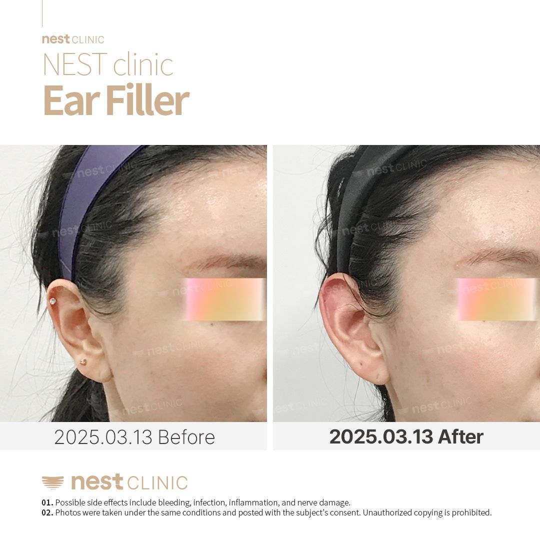 Ear Filler before and after — Nest Clinic Gangnam, patient 4