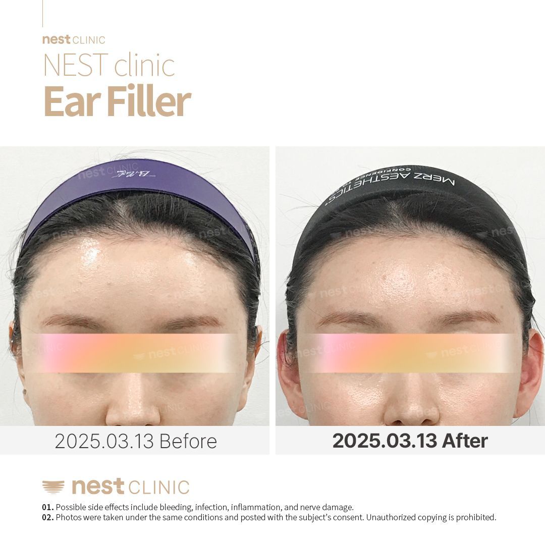 Ear Filler before and after — Nest Clinic Gangnam, patient 3