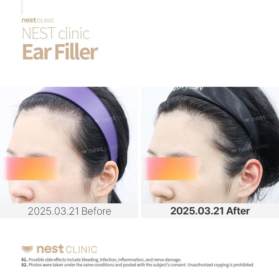 Ear Filler before and after — Nest Clinic Gangnam, patient 2