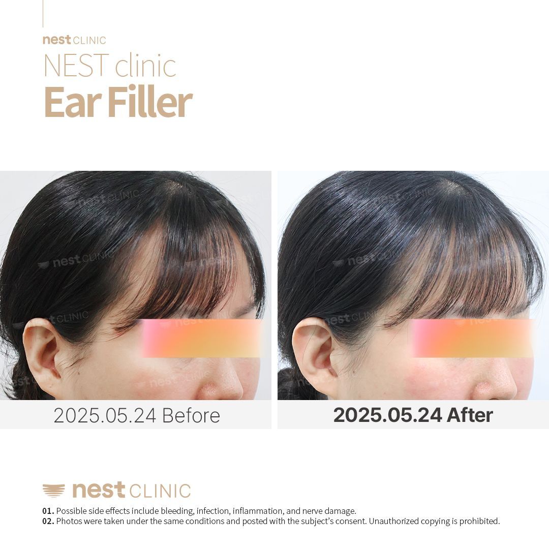 Ear Filler — Nest Clinic Gangnam