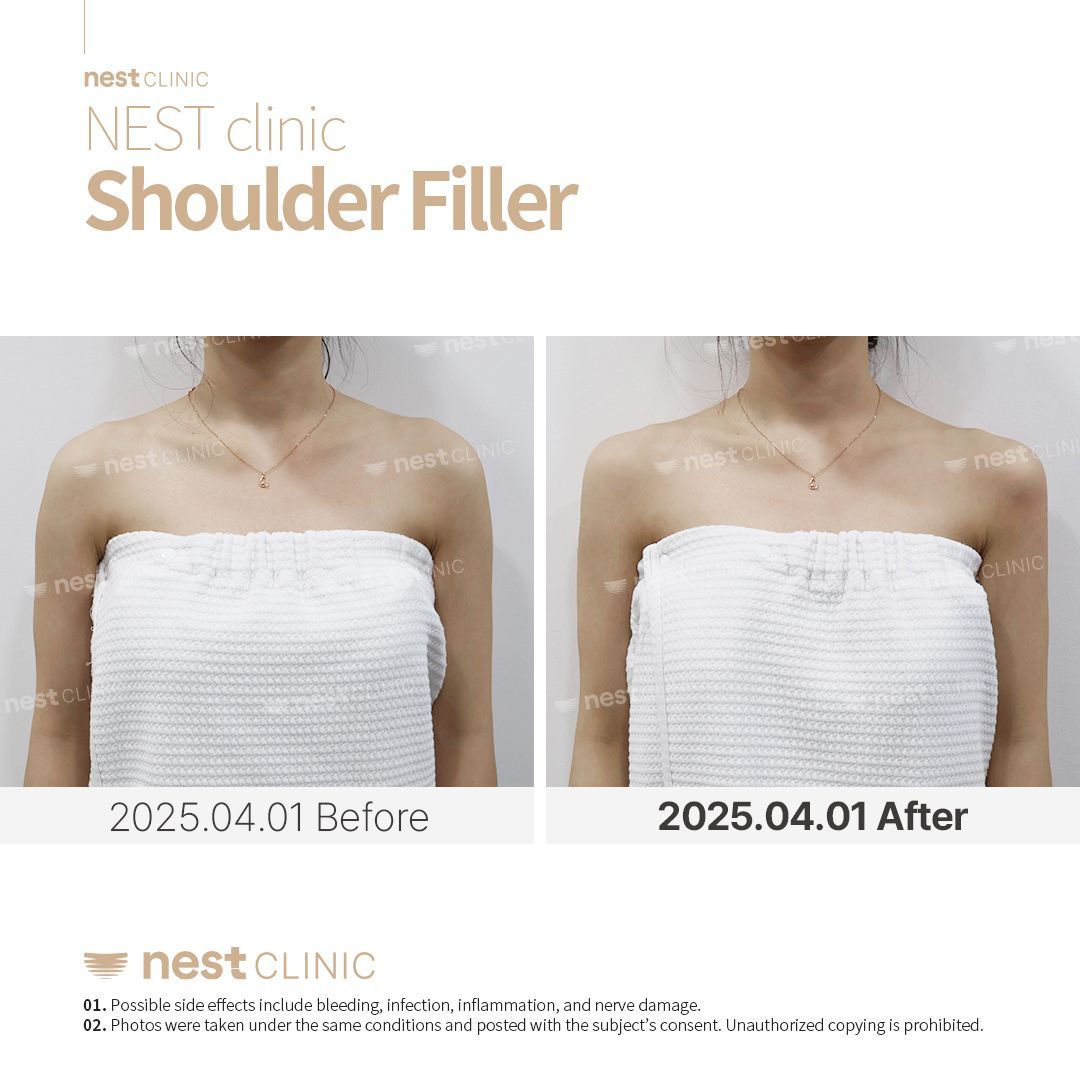 Shoulder Filler before and after — Nest Clinic Gangnam, patient 15