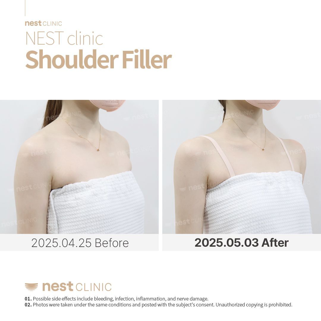 Shoulder Filler before and after — Nest Clinic Gangnam, patient 14