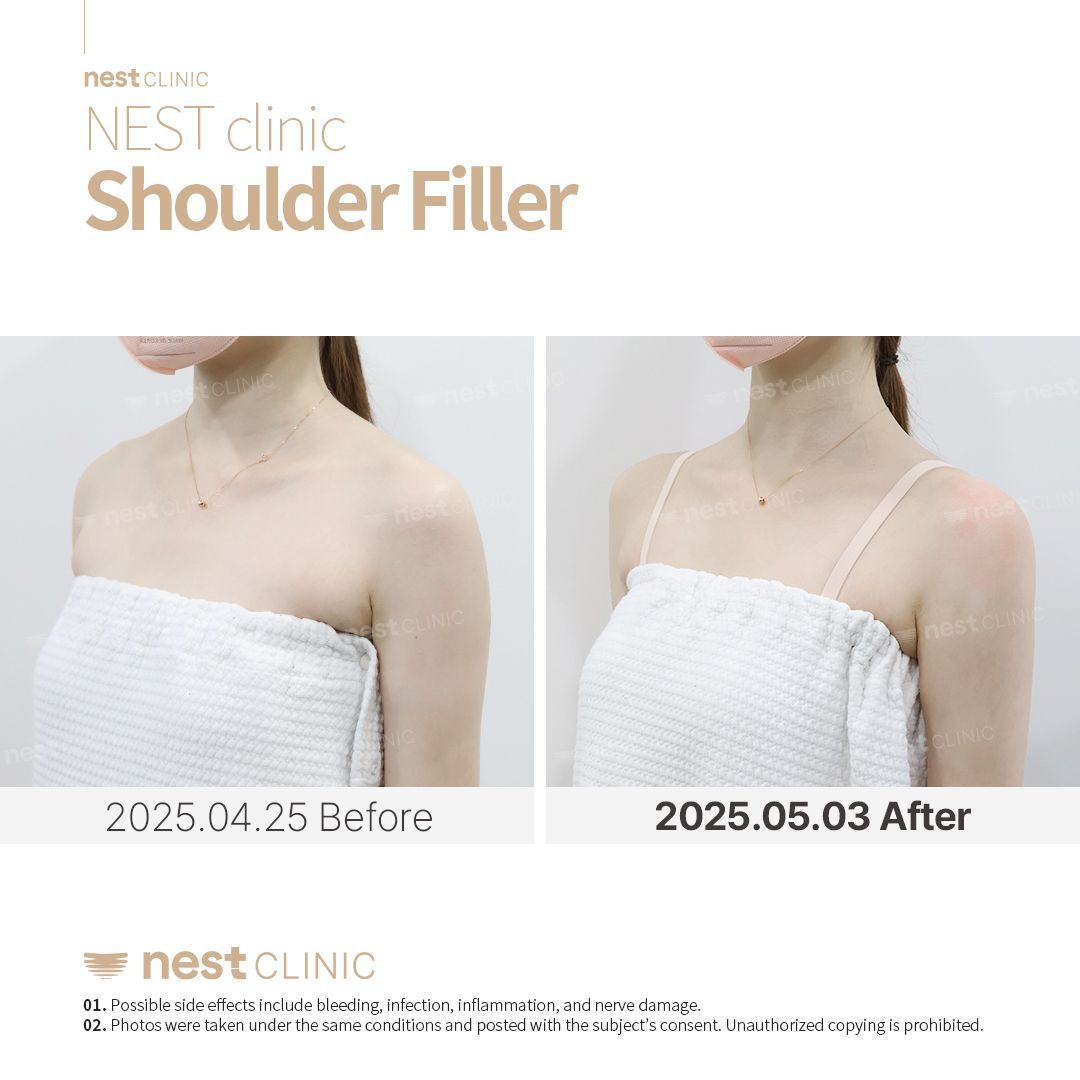 Shoulder Filler before and after — Nest Clinic Gangnam, patient 13