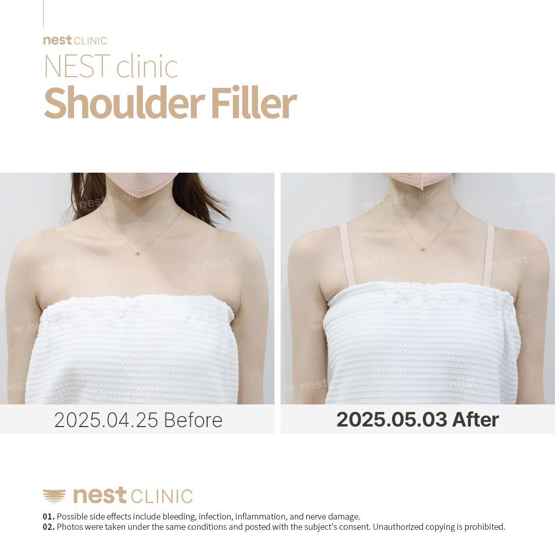 Shoulder Filler before and after — Nest Clinic Gangnam, patient 12