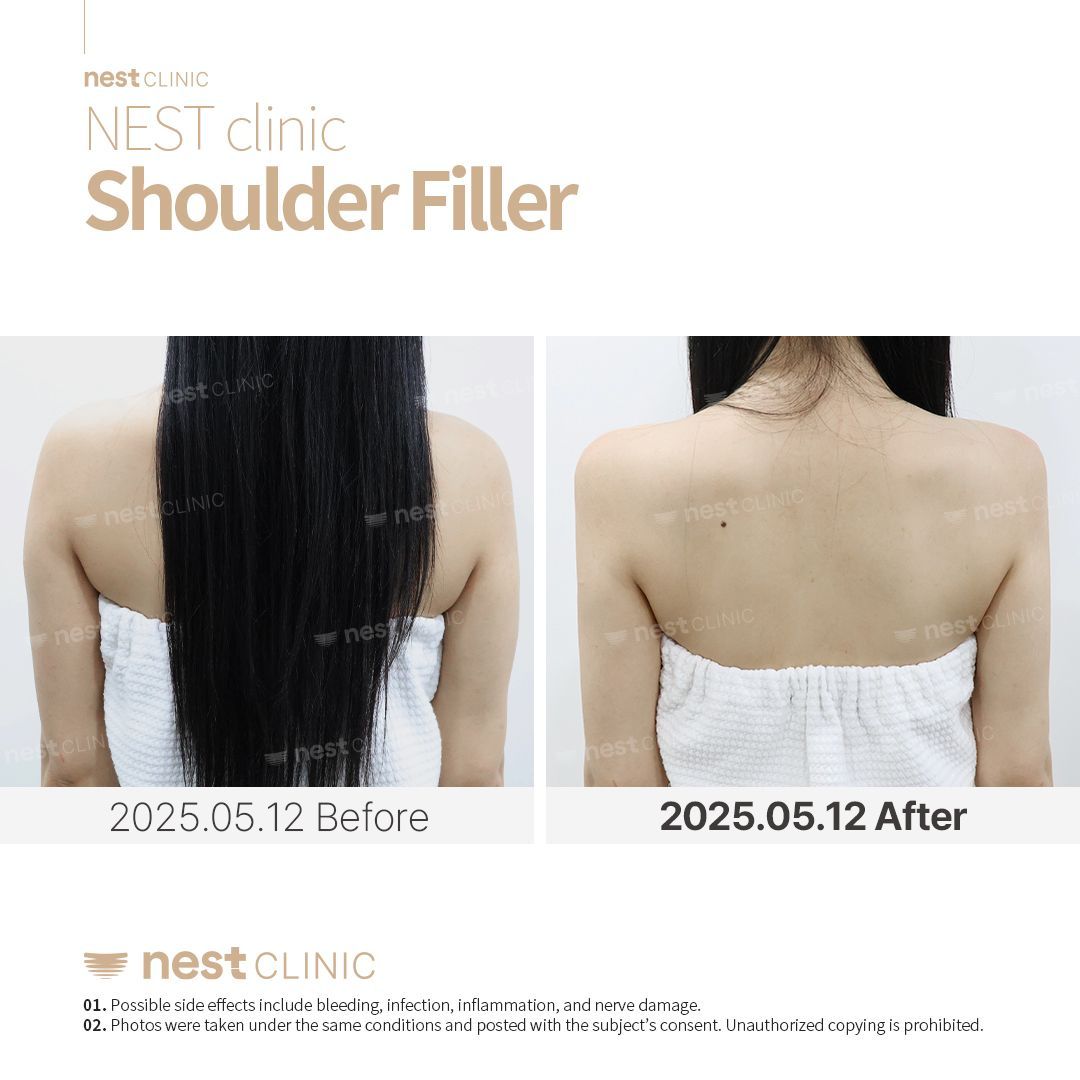 Shoulder Filler before and after — Nest Clinic Gangnam, patient 11