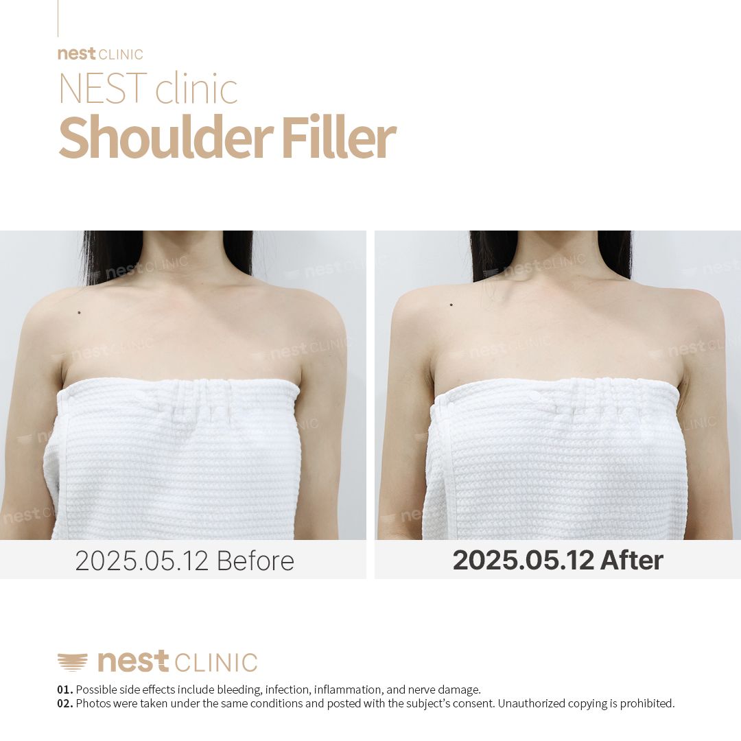 Shoulder Filler before and after — Nest Clinic Gangnam, patient 10
