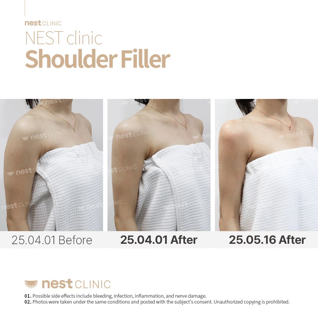 Shoulder Filler before and after — Nest Clinic Gangnam, patient 9