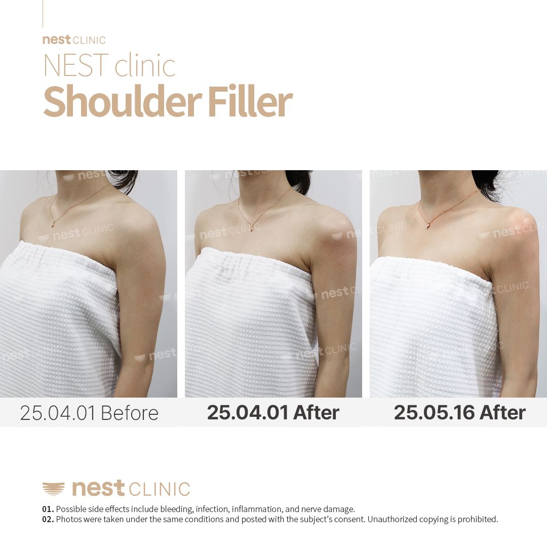 Shoulder Filler before and after — Nest Clinic Gangnam, patient 8