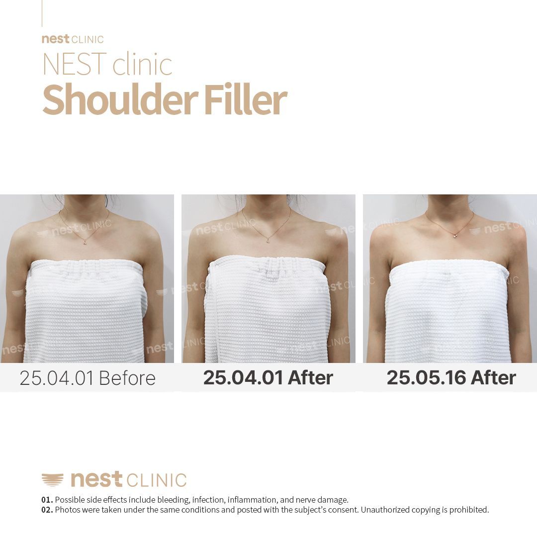 Shoulder Filler before and after — Nest Clinic Gangnam, patient 7