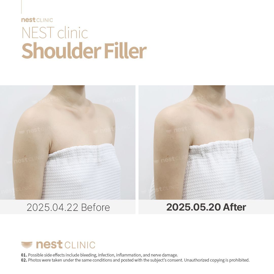 Shoulder Filler before and after — Nest Clinic Gangnam, patient 6