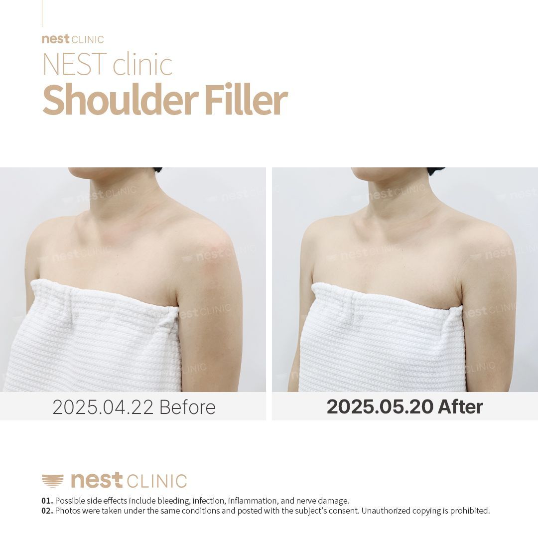 Shoulder Filler before and after — Nest Clinic Gangnam, patient 5