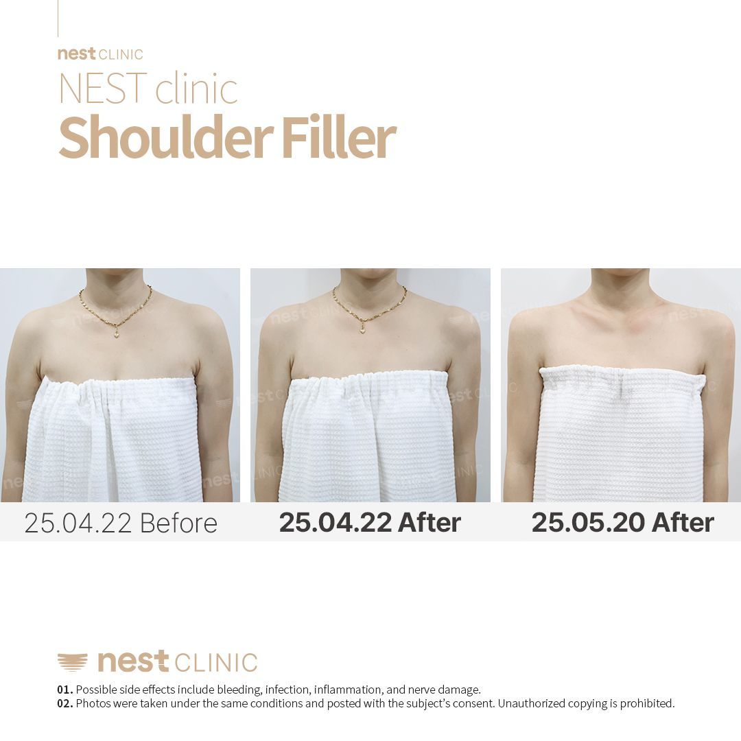 Shoulder Filler before and after — Nest Clinic Gangnam, patient 4