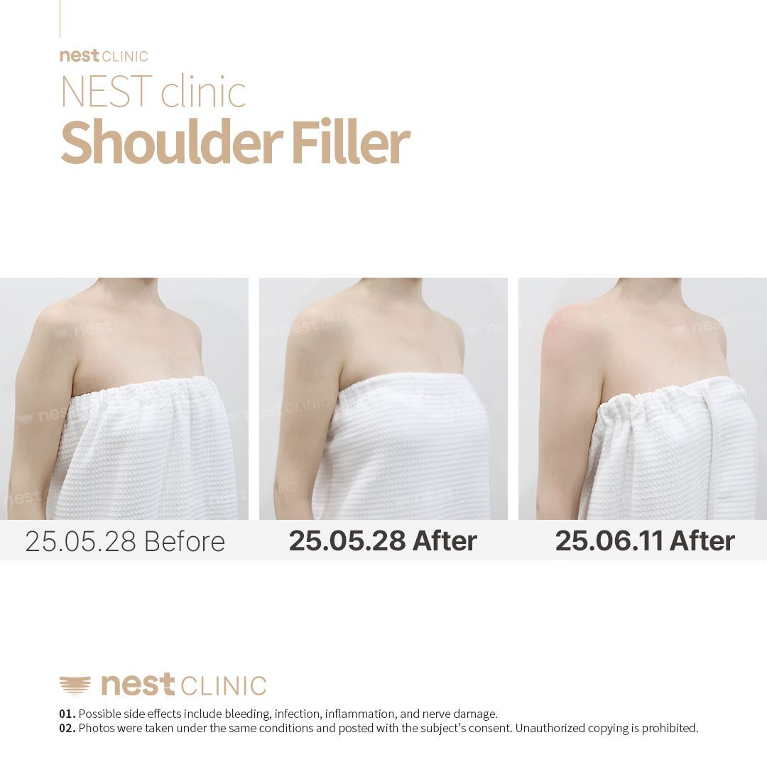 Shoulder Filler before and after — Nest Clinic Gangnam, patient 3
