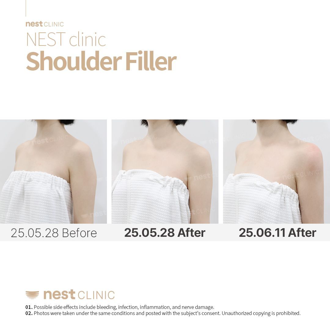 Shoulder Filler before and after — Nest Clinic Gangnam, patient 2