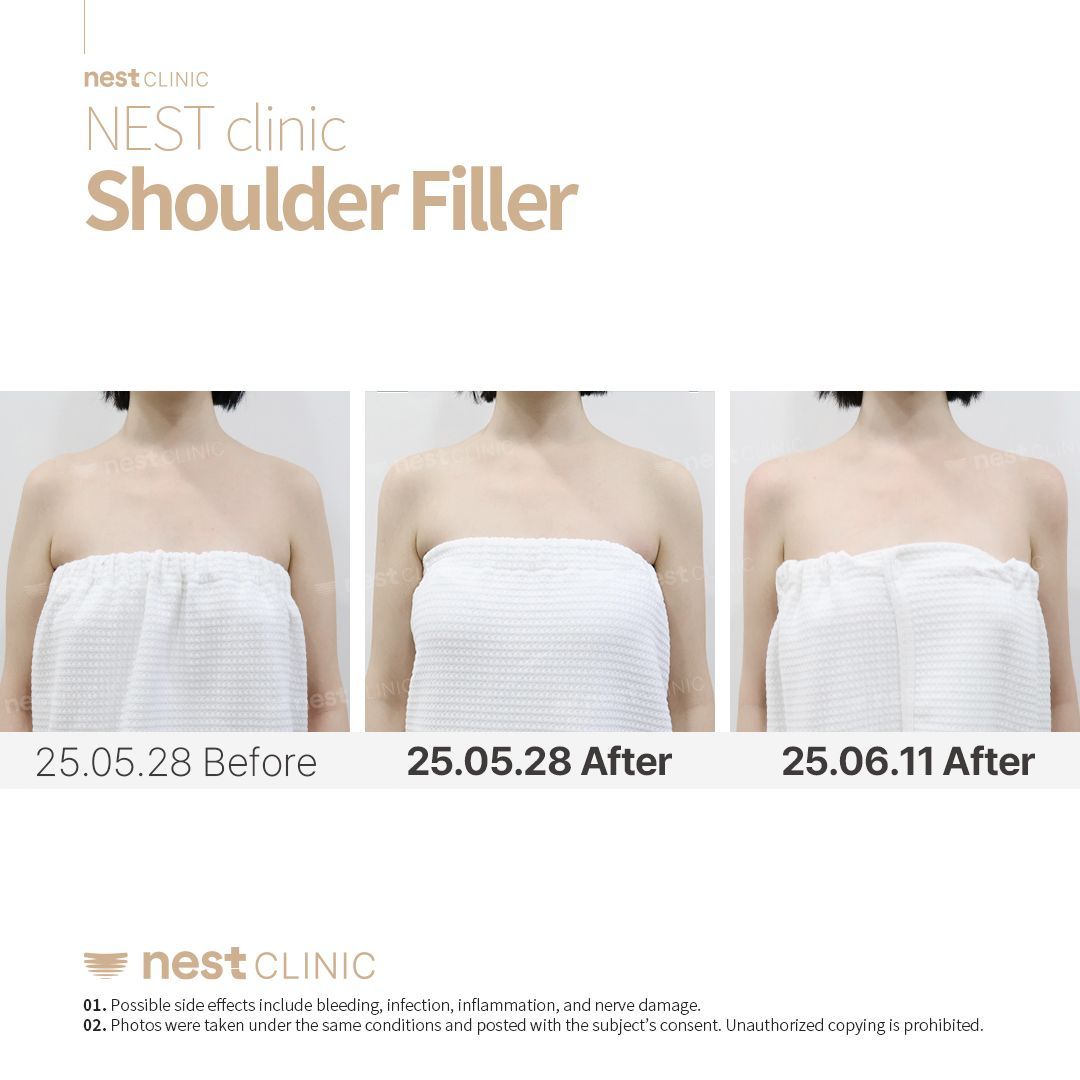 Shoulder Filler — Nest Clinic Gangnam