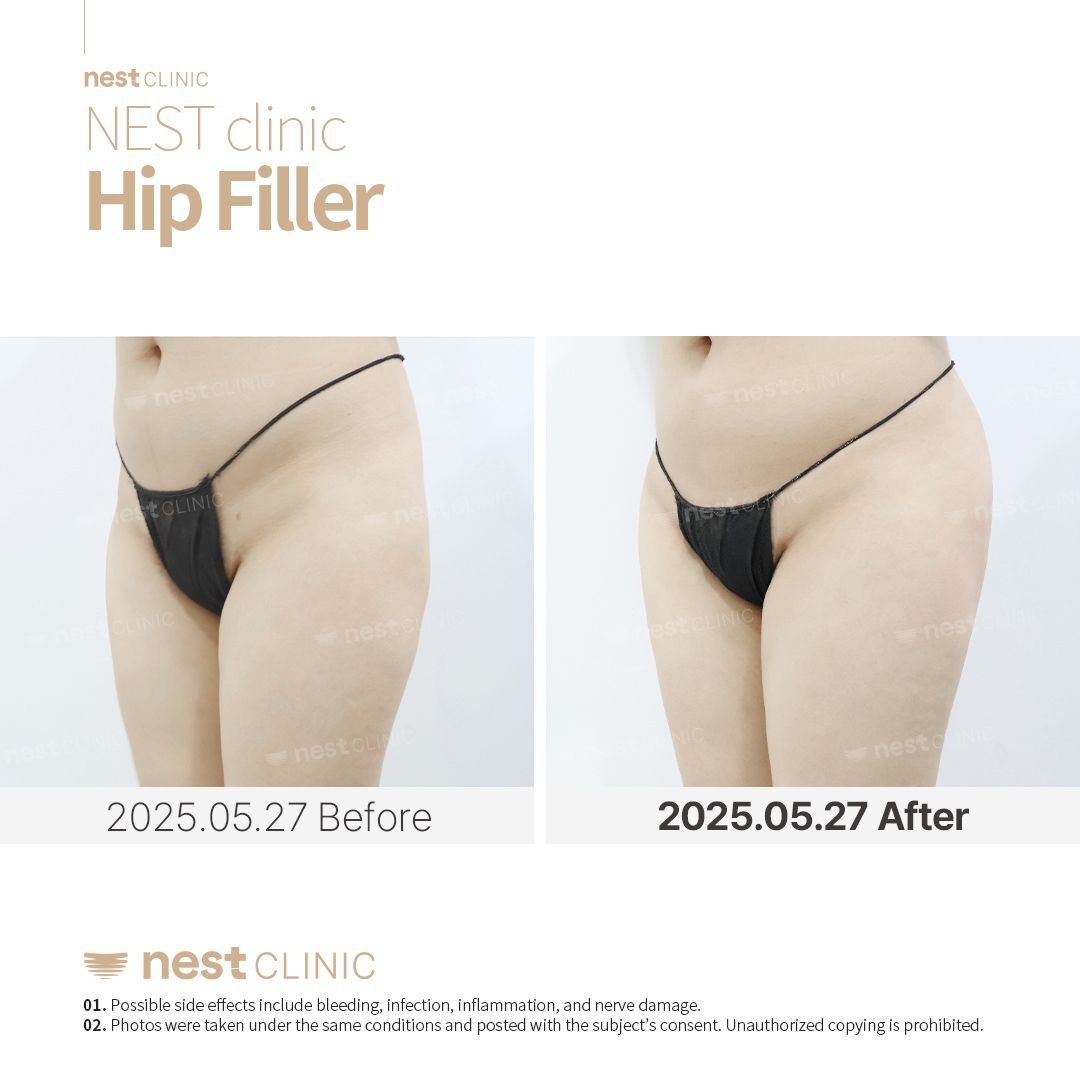 Hip Dip Filler before and after — Nest Clinic Gangnam, patient 6