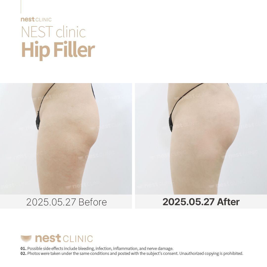 Hip Dip Filler before and after — Nest Clinic Gangnam, patient 5
