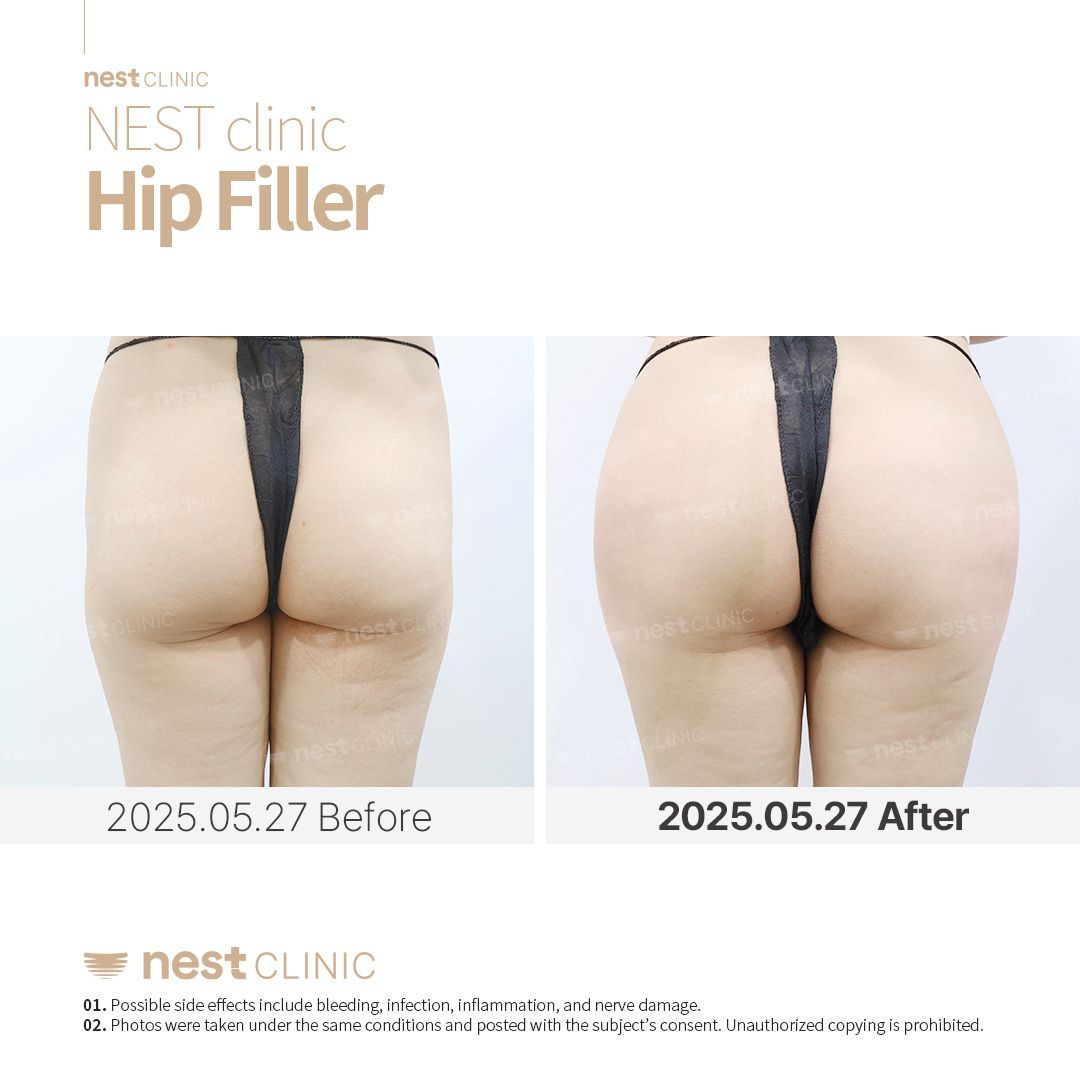 Hip Dip Filler before and after — Nest Clinic Gangnam, patient 4
