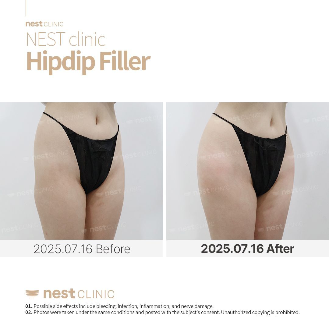 Hip Dip Filler before and after — Nest Clinic Gangnam, patient 3