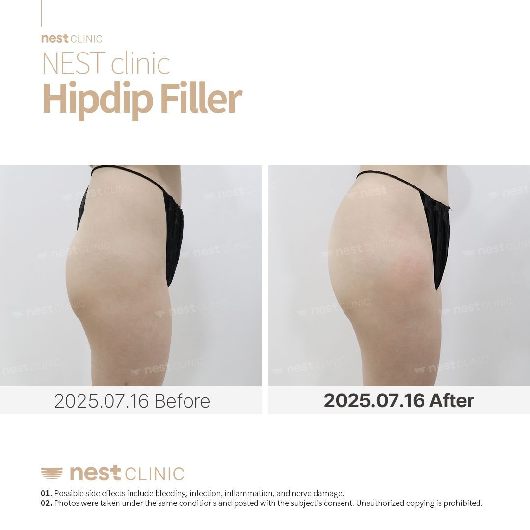 Hip Dip Filler before and after — Nest Clinic Gangnam, patient 2