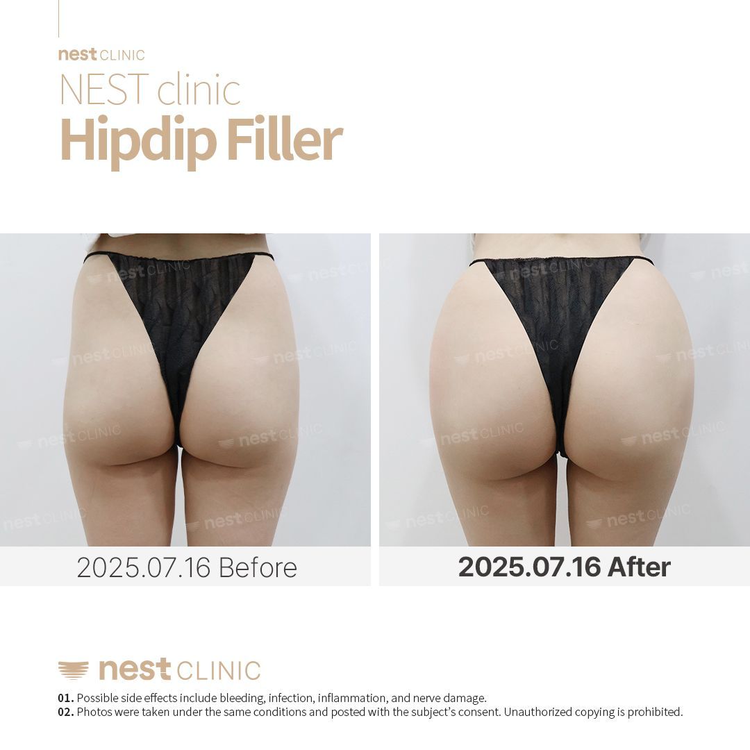 Hip Dip Filler — Nest Clinic Gangnam