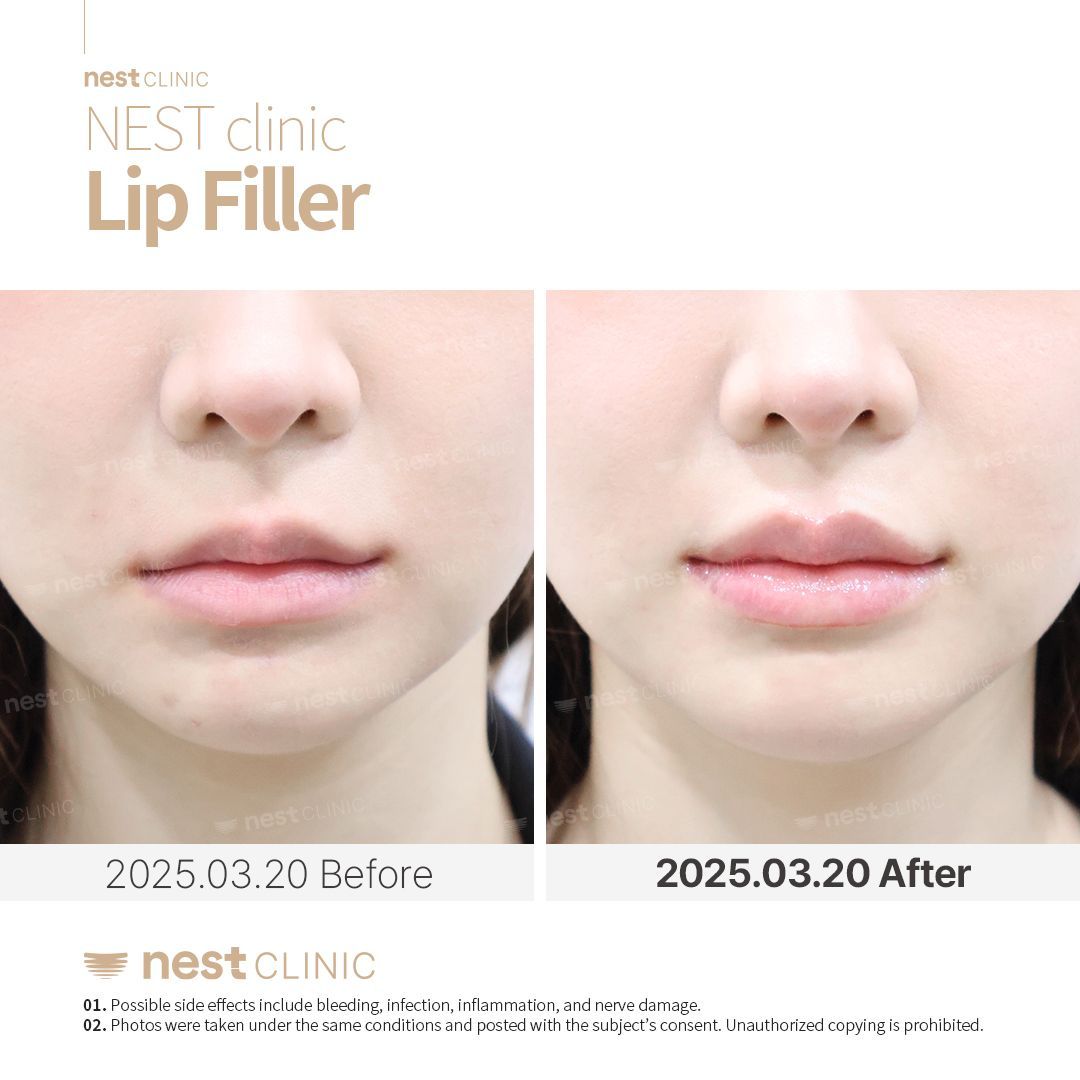 Lip Filler before and after — Nest Clinic Gangnam, patient 13