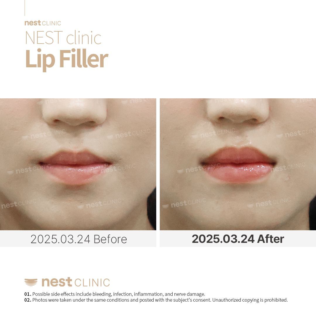 Lip Filler before and after — Nest Clinic Gangnam, patient 11