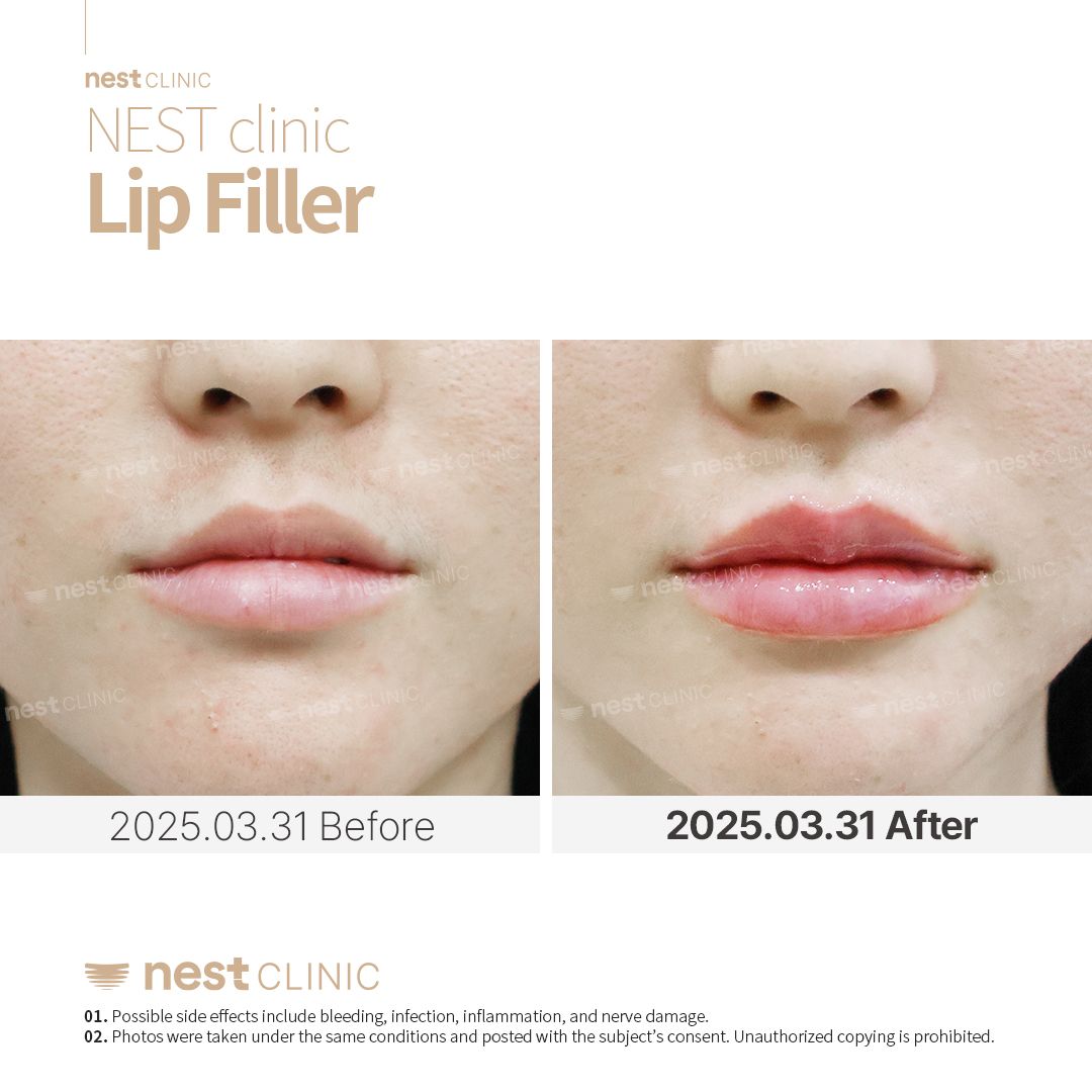 Lip Filler before and after — Nest Clinic Gangnam, patient 10