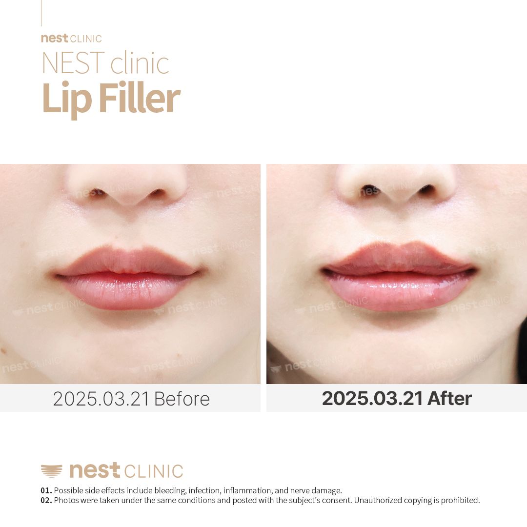 Lip Filler before and after — Nest Clinic Gangnam, patient 9