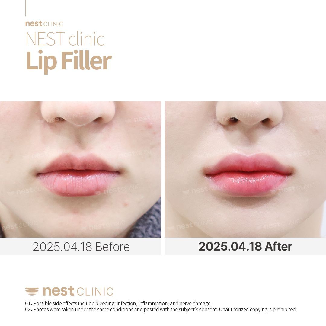 Lip Filler before and after — Nest Clinic Gangnam, patient 8